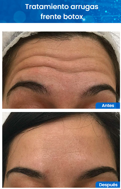 Resultados del botox antes y después en Clínica Estética Incorpore