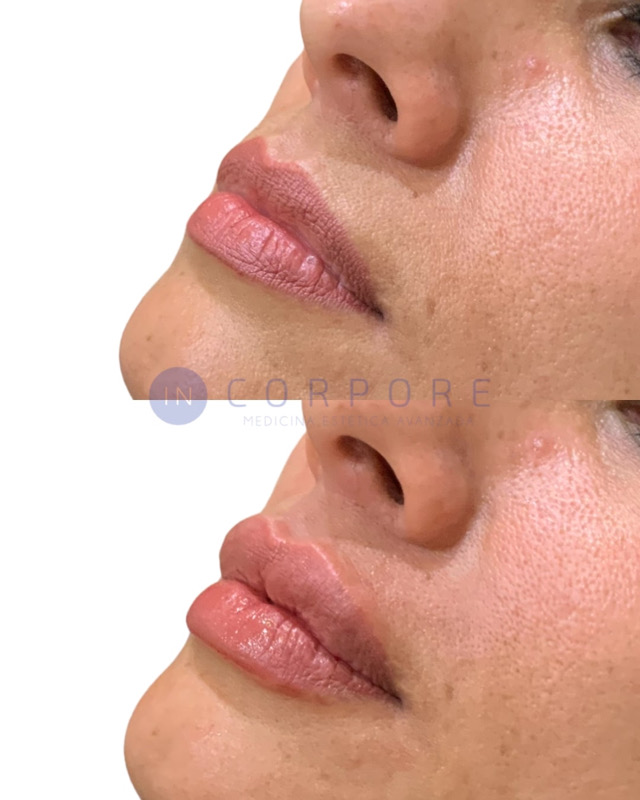 aumento de labios fuengirola con acido hialuronico