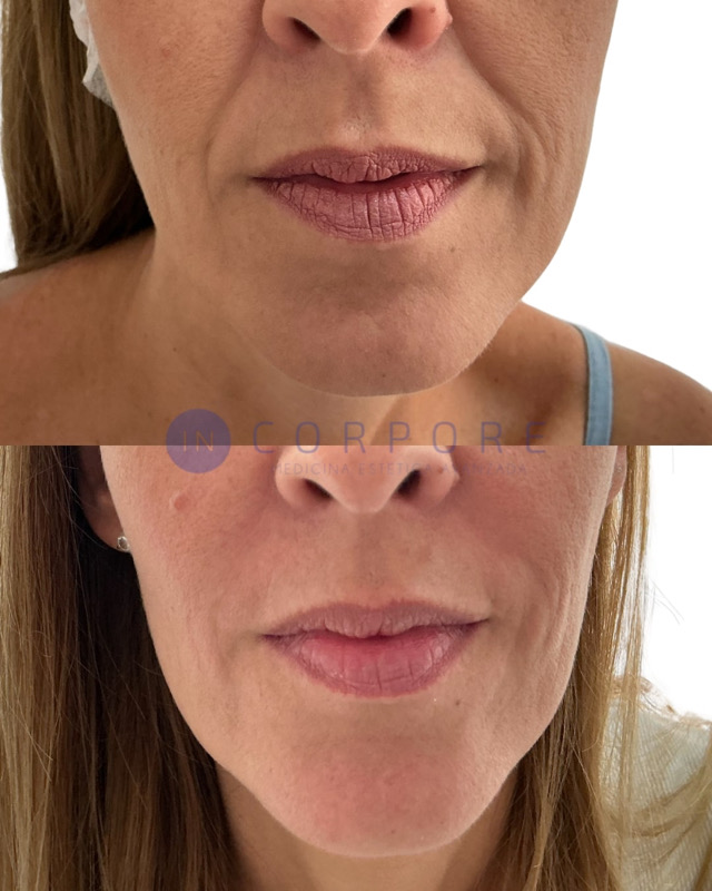 clinica aumento de labios malaga