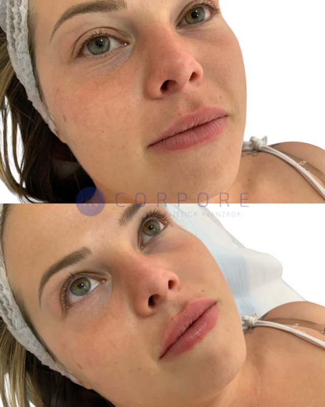 ofertas aumento de labios malaga