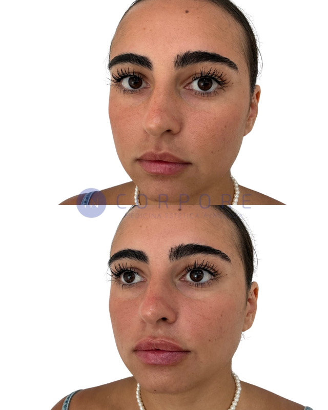 precio de aumento de labios en fuengirola