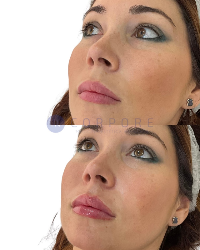 aumento de labios malaga opiniones