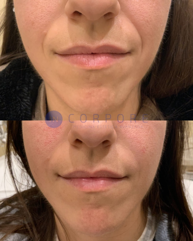 ponerme labios fuengirola