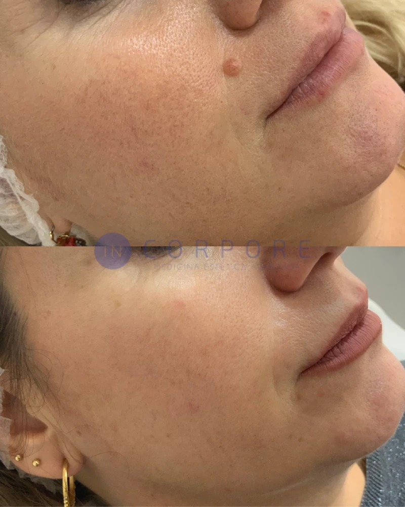 quitar verrugas resultados