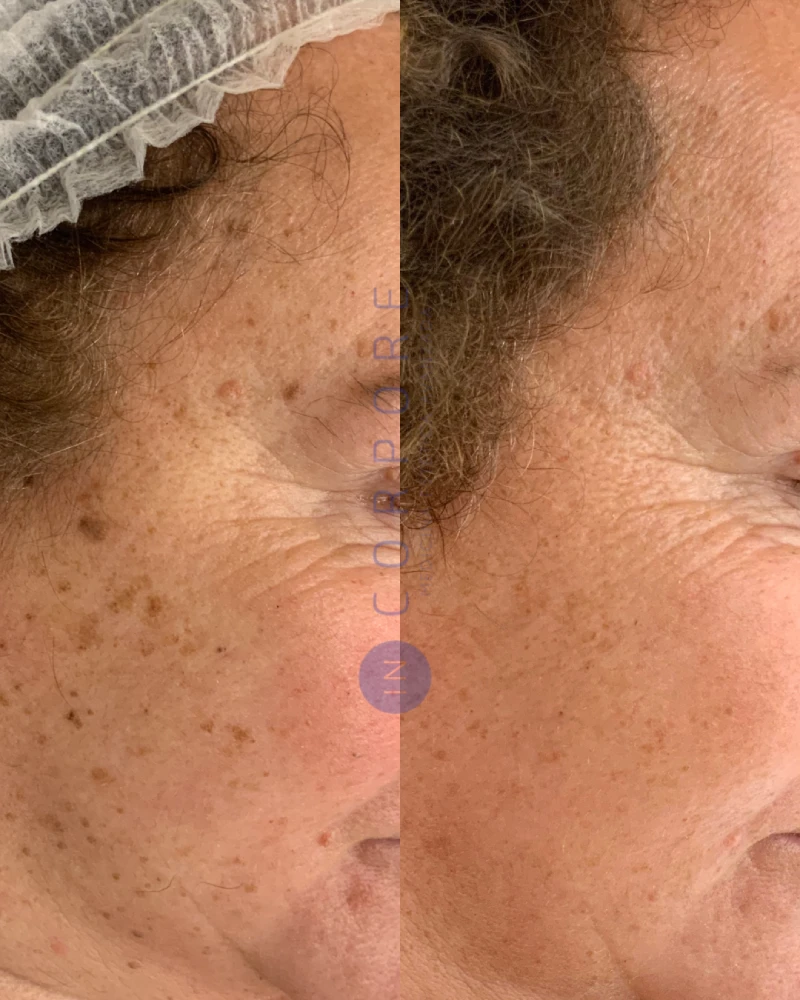 eliminar lunares con laser