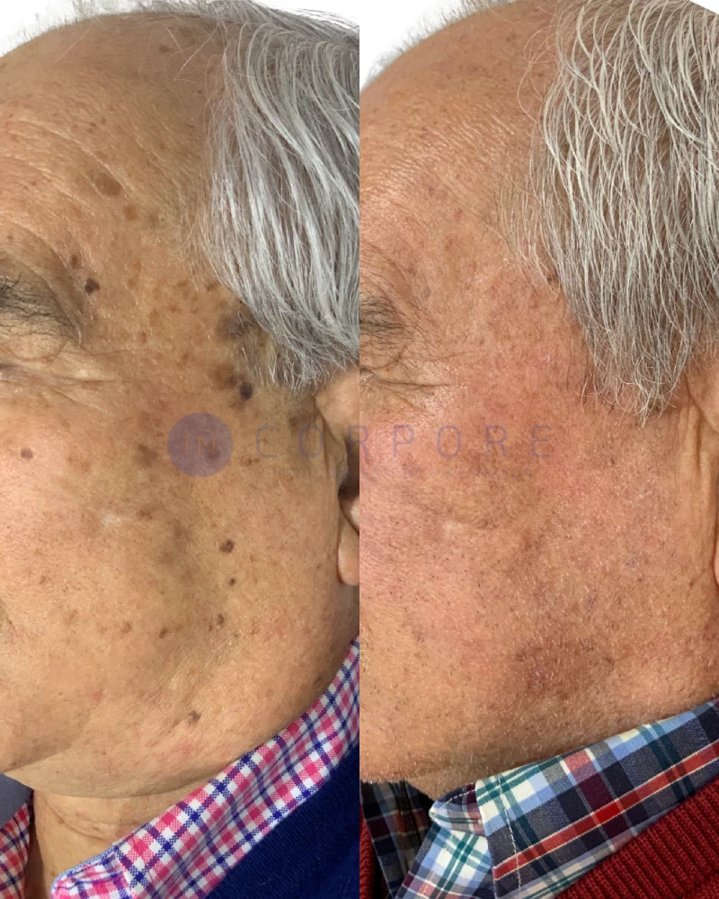 clinica para quitar lunares