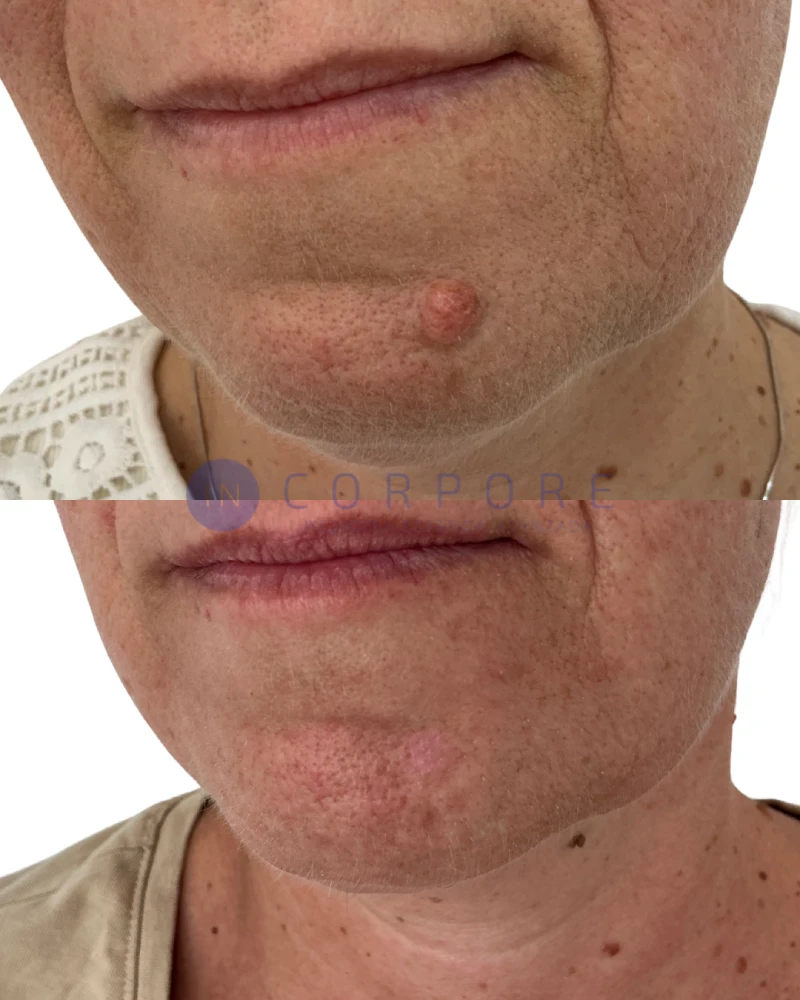 quitar verrugas antes despues clinica