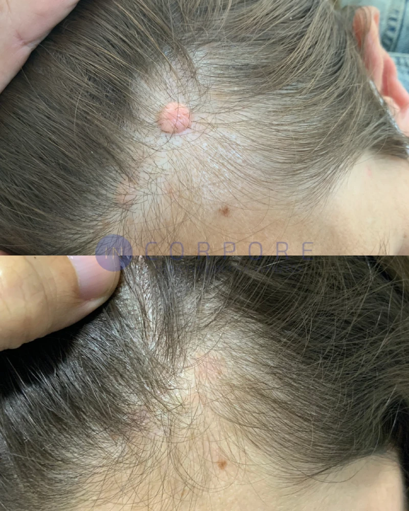 quitar verruga clinica privada