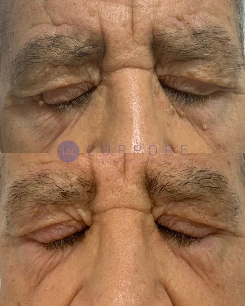 clinica eliminar verrugas